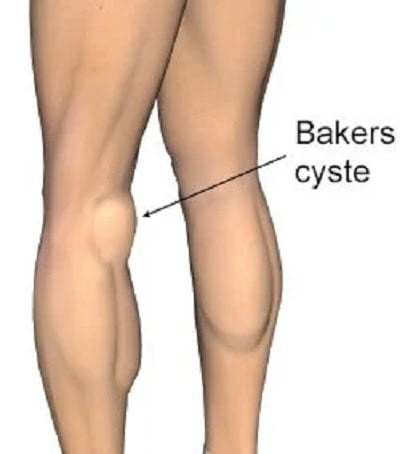 Baker Cyste