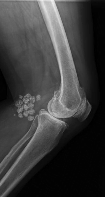 Behandlingsmuligehder Baker Cyste