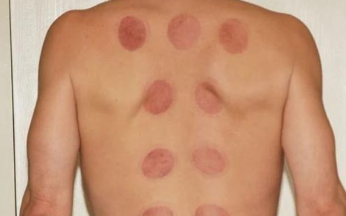 Cupping - Hvad videnskaben siger