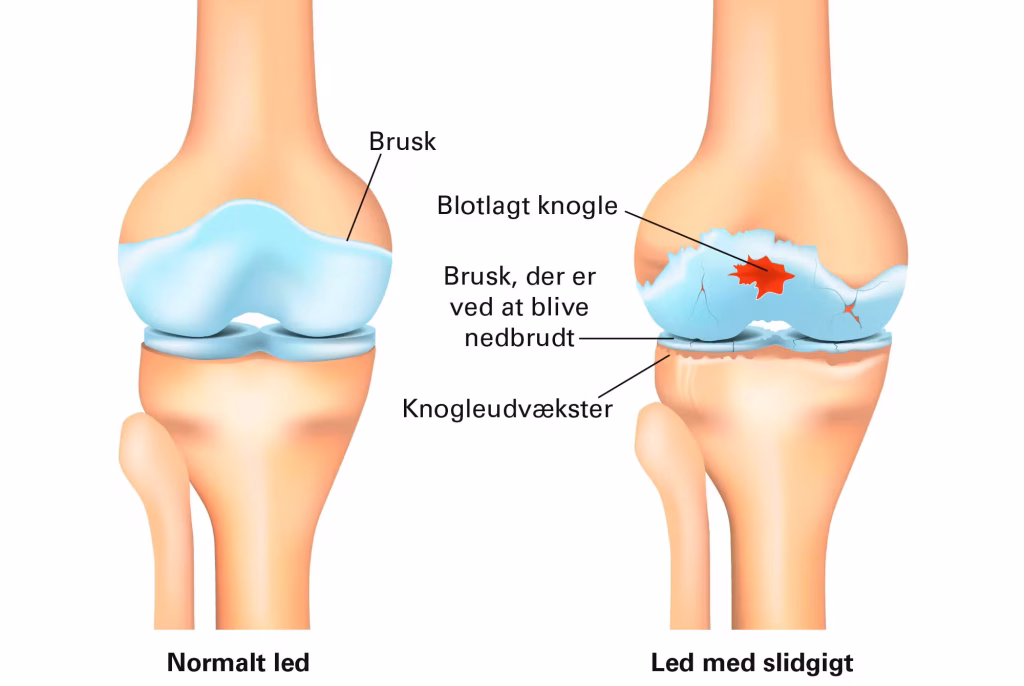 Slidgigt i Knæet vs normalt knæ