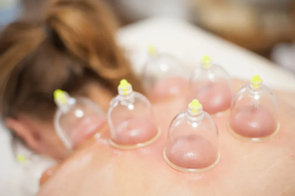Zency Behandlinger Cupping behandling